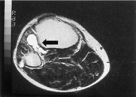 Figure 1 From Intraneural Ganglion Cyst Of The Peroneal Nerve Accompanied By Complete Foot Drop