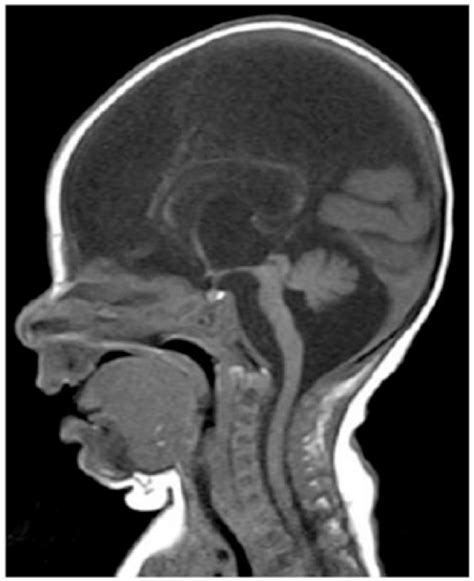 Sagittal Nuclear Magnetic Resonance Image Depicting Hydranencephaly