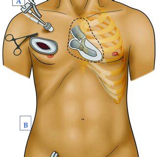 PDF Femoral Or Axillary Cannulation For Extracorporeal Circulation