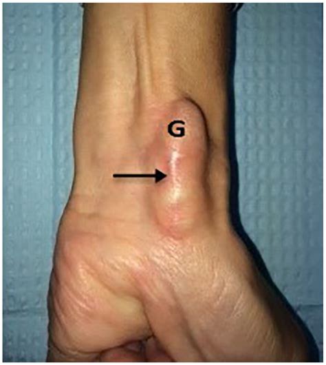 Wrist Ganglion