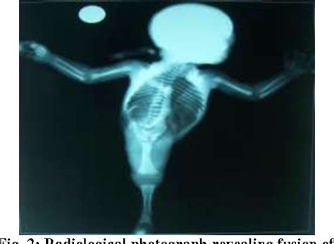 Sirenomelia Syndrome X Ray