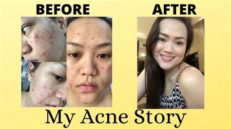 How I Cleared My Skin Acne Accutane Journey Youtube