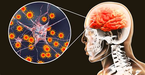 Encephalitis | Symptoms, Causes, Treatment, Types & Diagnosis