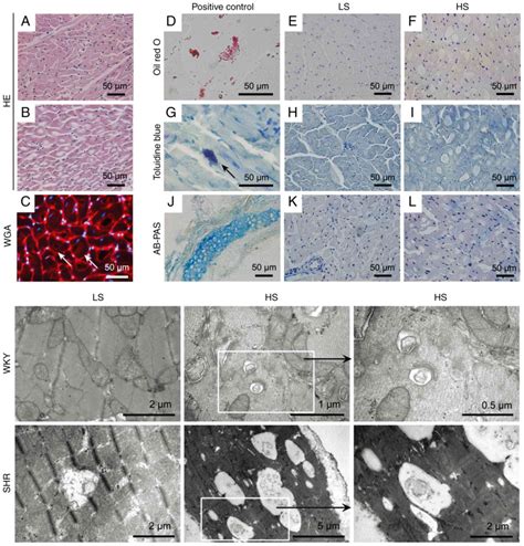 Chronic Highsalt Intake Induces Cardiomyocyte Autophagic Vacuolization