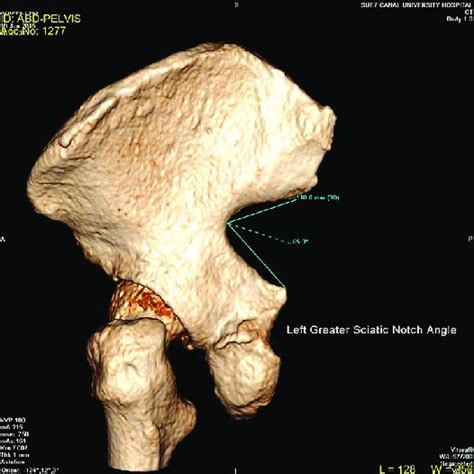 Three Dimensional Computed Tomography Reconstruction Of The Pelvis