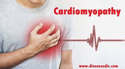 Cardiomyopathy – Types, Causes and Prevention