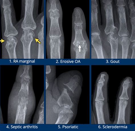 Rheumatoid Arthritis X Ray Knee