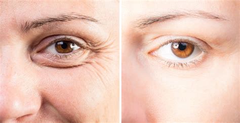 Can Eyelid Lifts Affect Your Vision Popp Cosmetic Surgery