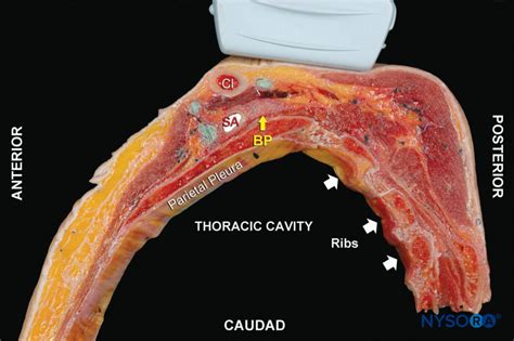 Bloqueo Del Nervio Del Plexo Braquial Supraclavicular Guiado Por