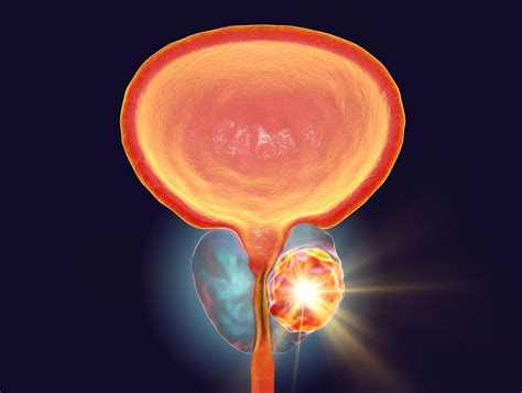 Comparison of Androgen Receptor Inhibitors for Nonmetastatic Castration ...