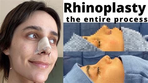 I Got a Rhinoplasty in Los Angeles | What it's REALLY Like - YouTube