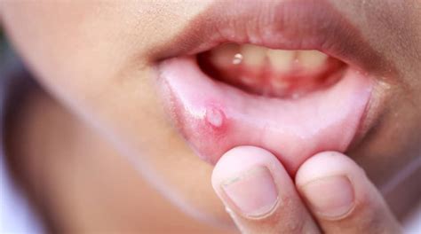 Aphthous Ulcers Symptoms Causes And Treatment Healthtian