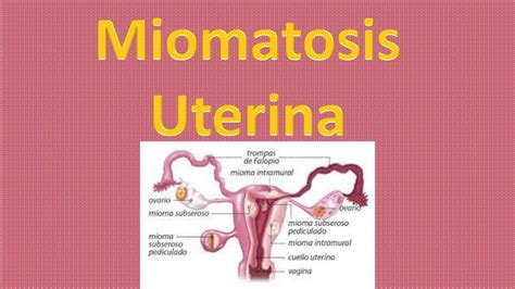 Miomatosis Uterina Maryuri Lisbeth Udocz