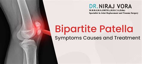 Bipartite Patella Symptoms Causes And Treatment Dr Niraj Vora Dr Niraj Vora