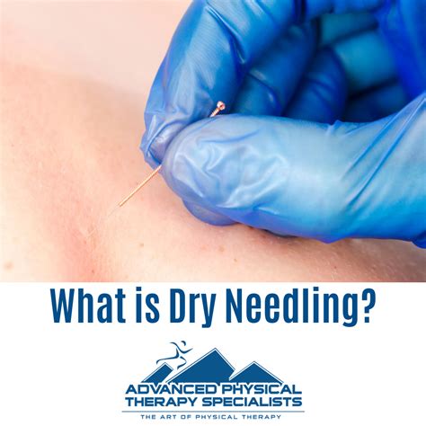 What Is Dry Needling Advanced Physical Therapy Specialists