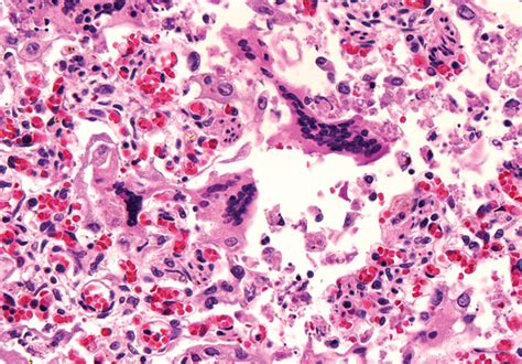 Respiratory Syncytial Virus (RSV) Infection | Diseases & Conditions ...