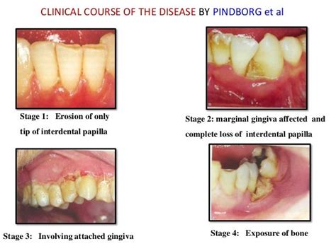 Necrotising Periodontal Diseases