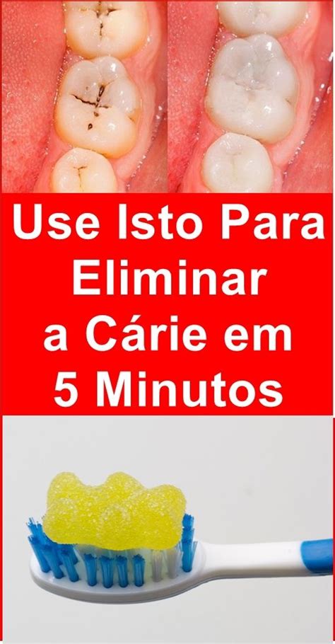 Cárie Dentária Como Eliminar As Cáries Com Apenas Essa Receita Cárie