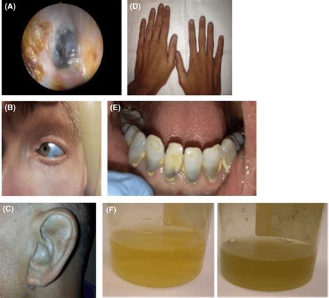 A Blue Tympanic Membrane B Blue Discoloration Of The Sclera C Download Scientific