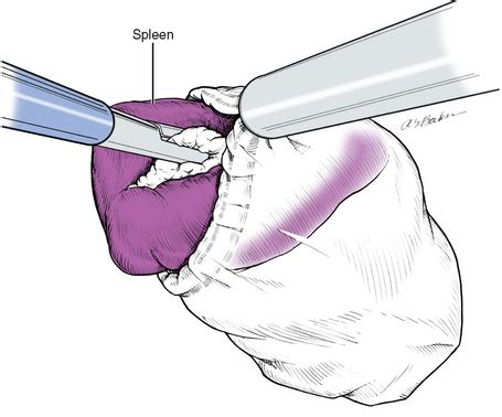 Supraclavicular Lymph Node Biopsy | Basicmedical Key