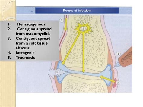 Musculoskeletal Block Pathology Osteomyelitis And Septic Arthritis