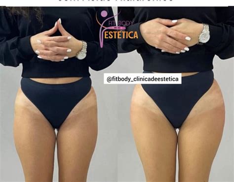 Arquivos depressão trocantérica antes e depois Clínica Fit Body Estética