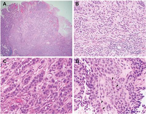 Adenocarcinoma Colon Histology