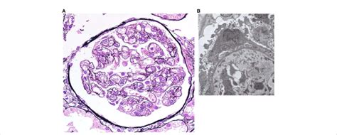 A Light Microscopy Shows Diffuse Global Endocapillary Proliferative