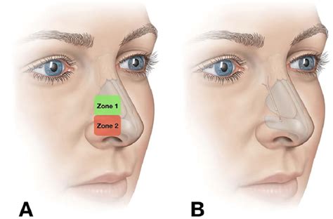 Internal Nasal Valve Anatomy