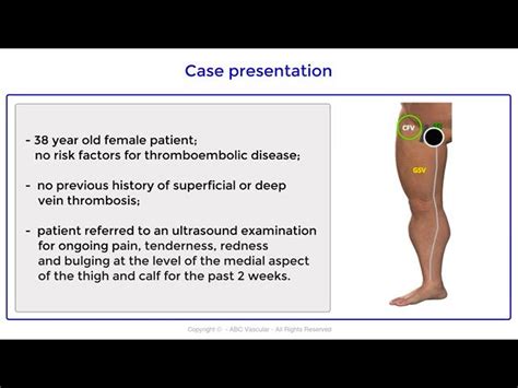 Superficial Thrombophlebitis Groin