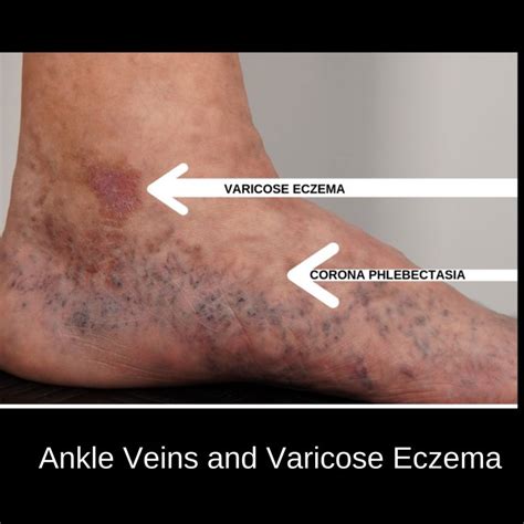 Veins Around Ankles The Veincare Centre