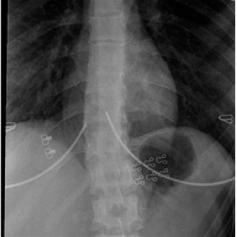 B Thoracic Radiography Shows Thoracolumbar Scoliosis With An S Form