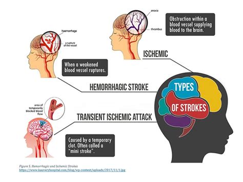 Stroke Chep 1100health Promotion