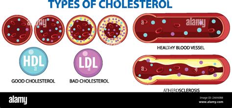 Illustration Of HDL LDL And Atherosclerosis In Blood Vessels Stock