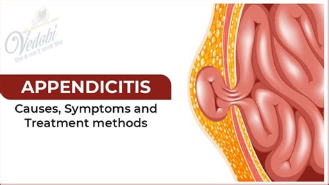 Vedobi Appendicitis Causes Symptoms And Treatment Methods