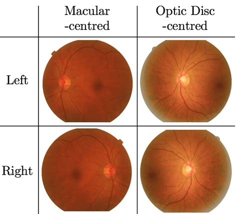 Examples Of Left Versus Right And Macular Versus Optic Disc Centred