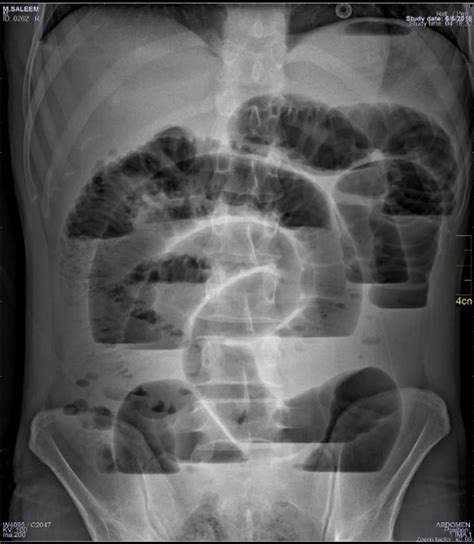 Valvuli Conniventis Rigler Sign Centrally Located Dilated Bowel