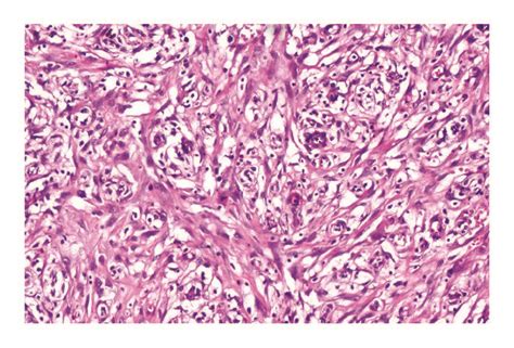 Proliferation Of Small Caliber Blood Vessels With Turgescent