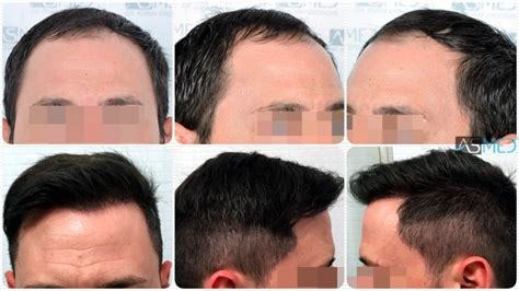 Norwood 3 Hair Transplantation Results | Asmed Hair Transplant