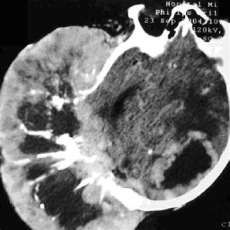 Cranial Computed Tomography Scan On Axial View Revealing A Large Skull