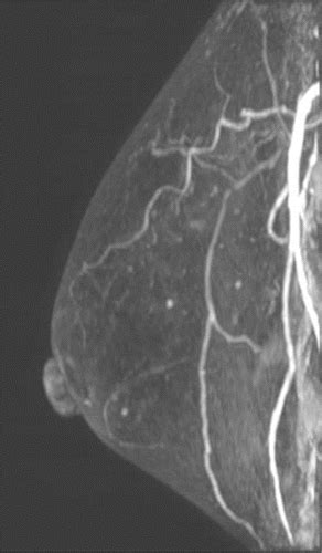 Axillary Nodal Evaluation In Breast Cancer State Of The Art Radiology