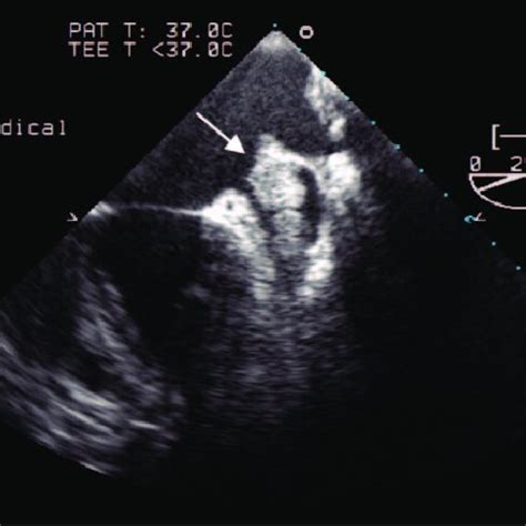 Transesophageal echocardiography showing large left atrial appendage ...