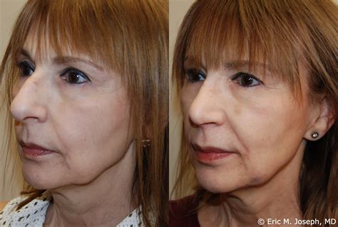 Eric M Joseph Md Rhinoplasty Before And After Hanging Columella And