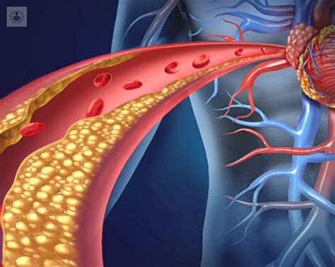 Causas De La Hipercolesterolemia Y Otras Enfermedades Vasculares Top