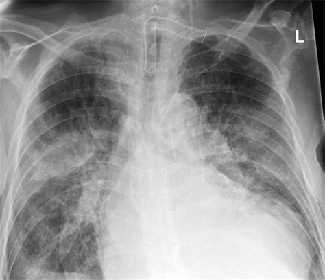 Pneumonia Radiology Key