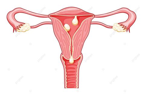 Cross Sections Of Uterus With Cervical Polyps Cervix Cancer Vaginal