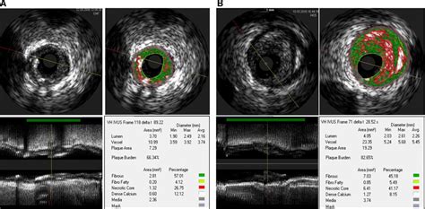 Effect Of Obesity On Coronary Atherosclerosis And Outcomes Of