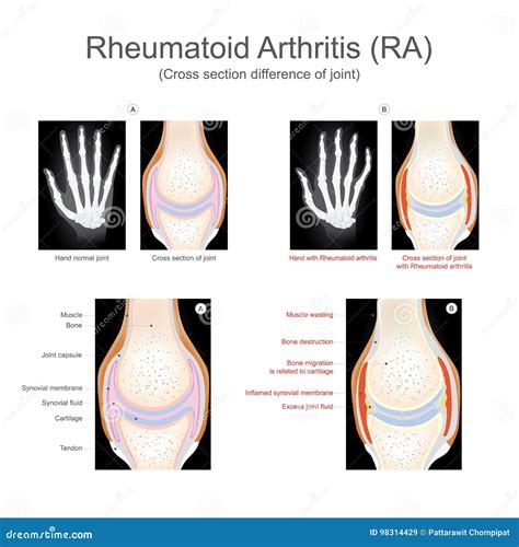 Rheumatoid Arthritis Stock Vector Illustration Of Fluid 98314429