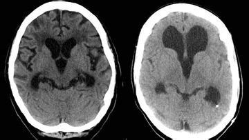 Severe Hydrocephalus Mri