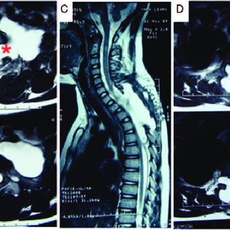 Anterior Sacral Meningocele In Patient 2 Sagittal A And Axial